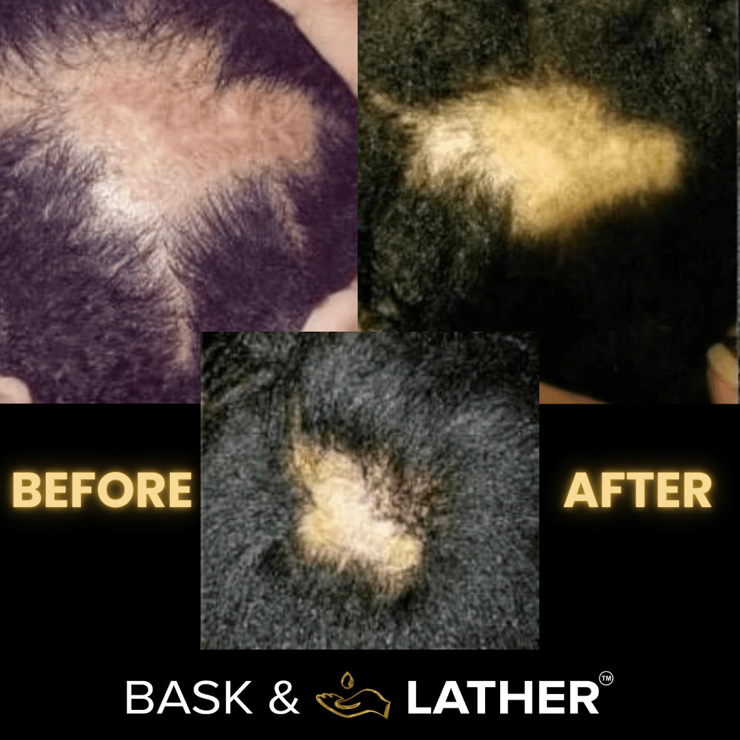 Scalp Stimulator | Hair Growth Oil